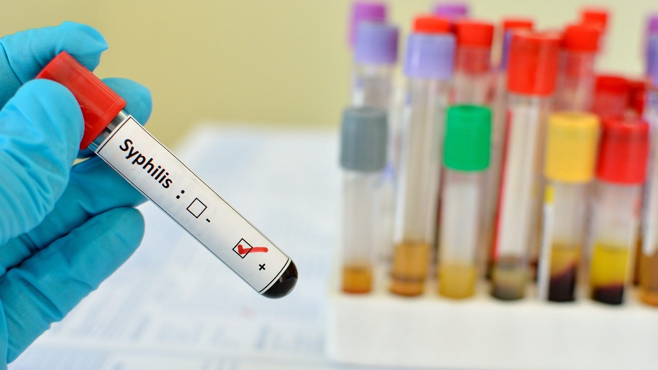 Congenital Syphilis Cases Surge Across the United States, Including Florida Gloved hand holding a test tube labeled 'Syphilis' with a positive result mark; colorful vials in the background.